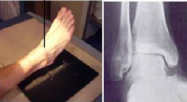 Proyección AP Tobillo